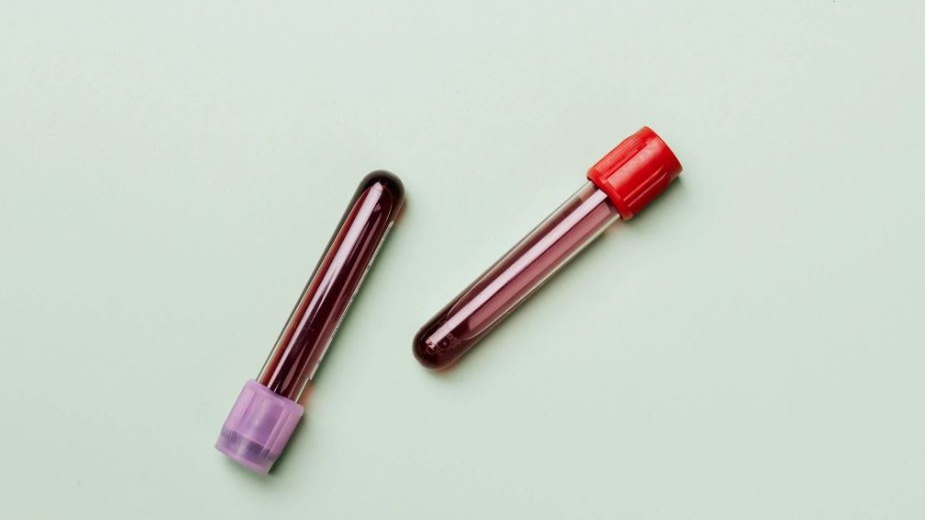 Malattie mentali: dall'esame di una goccia di sangue si può rilevare l'Alzheimer