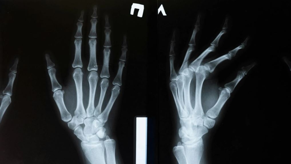 La cartilagine perduta per invecchiamento o artrite potrebbe essere ripristinata bloccando una proteina