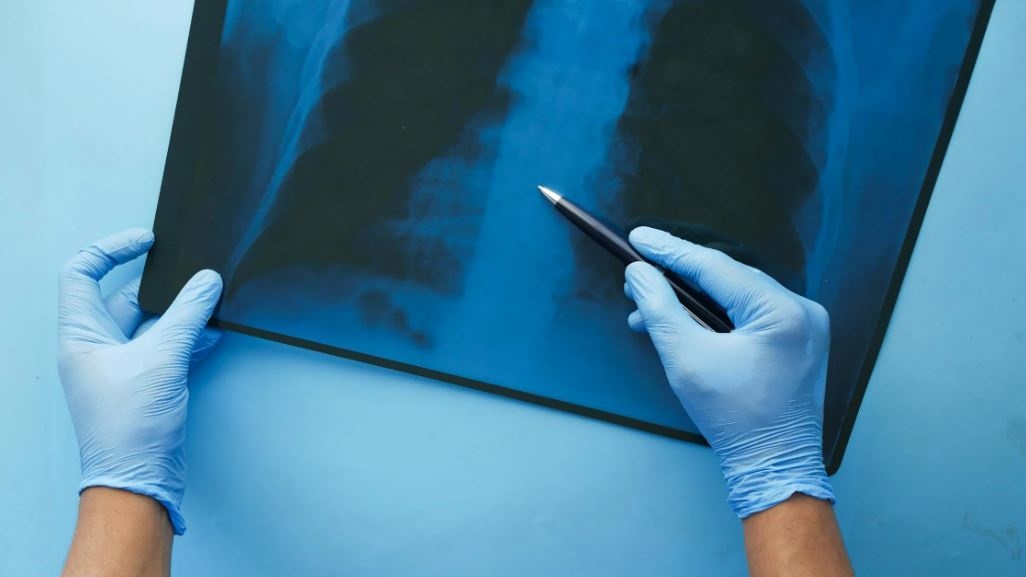 Dai vaccini all’aria pulita: la strategia per battere la polmonite