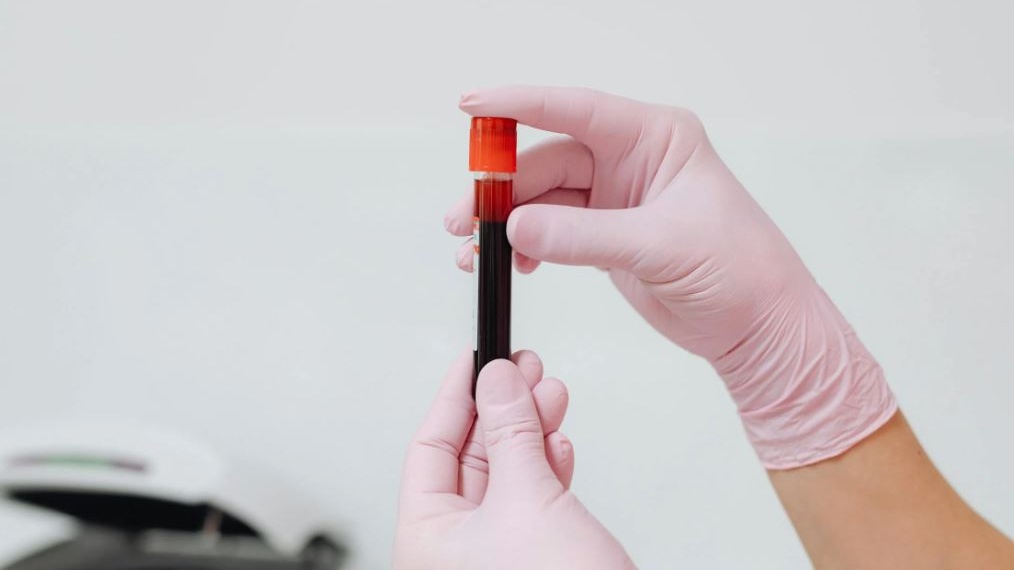 Tumori: test del sangue identifica ampia gamma di tumori, accelerandone la diagnosi