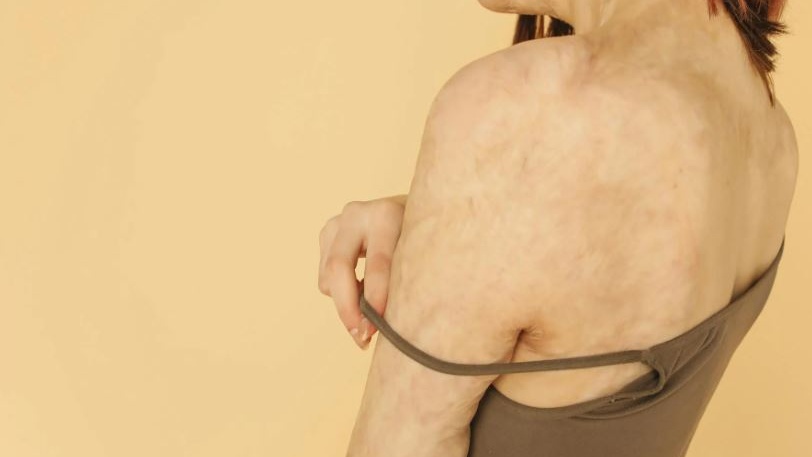 Da un gel rivoluzionario la speranza di cancellare le cicatrici da ustioni