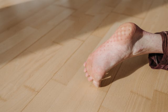 Diabete e piede di Charcot, perché la diagnosi precoce salva la mobilità