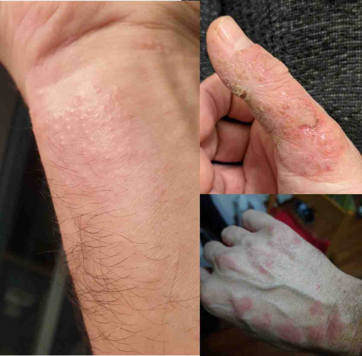 Eczema cronico delle mani, svolta in Italia: arriva delgocitinib, primo pan-JAK topico