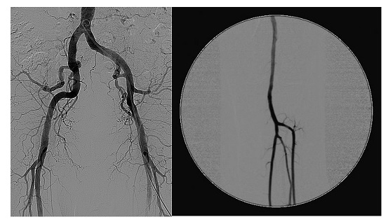 CO₂ in angiografia: alternativa sicura allo iodio