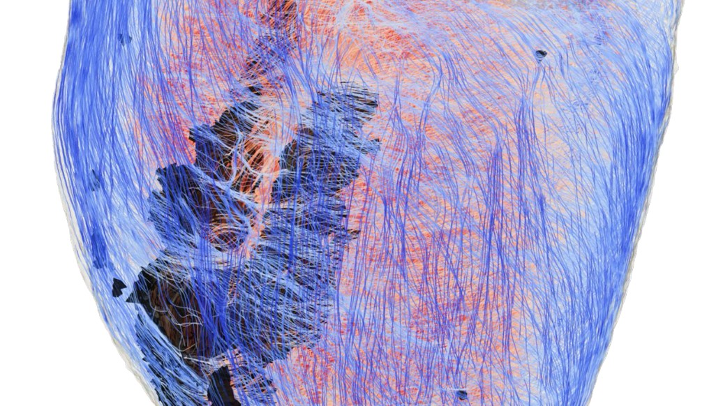 Svelato il legame tra fibrosi cardiaca e aritmie: la scoperta del Cnr-Ifc rivoluziona la cardiologia di precisione