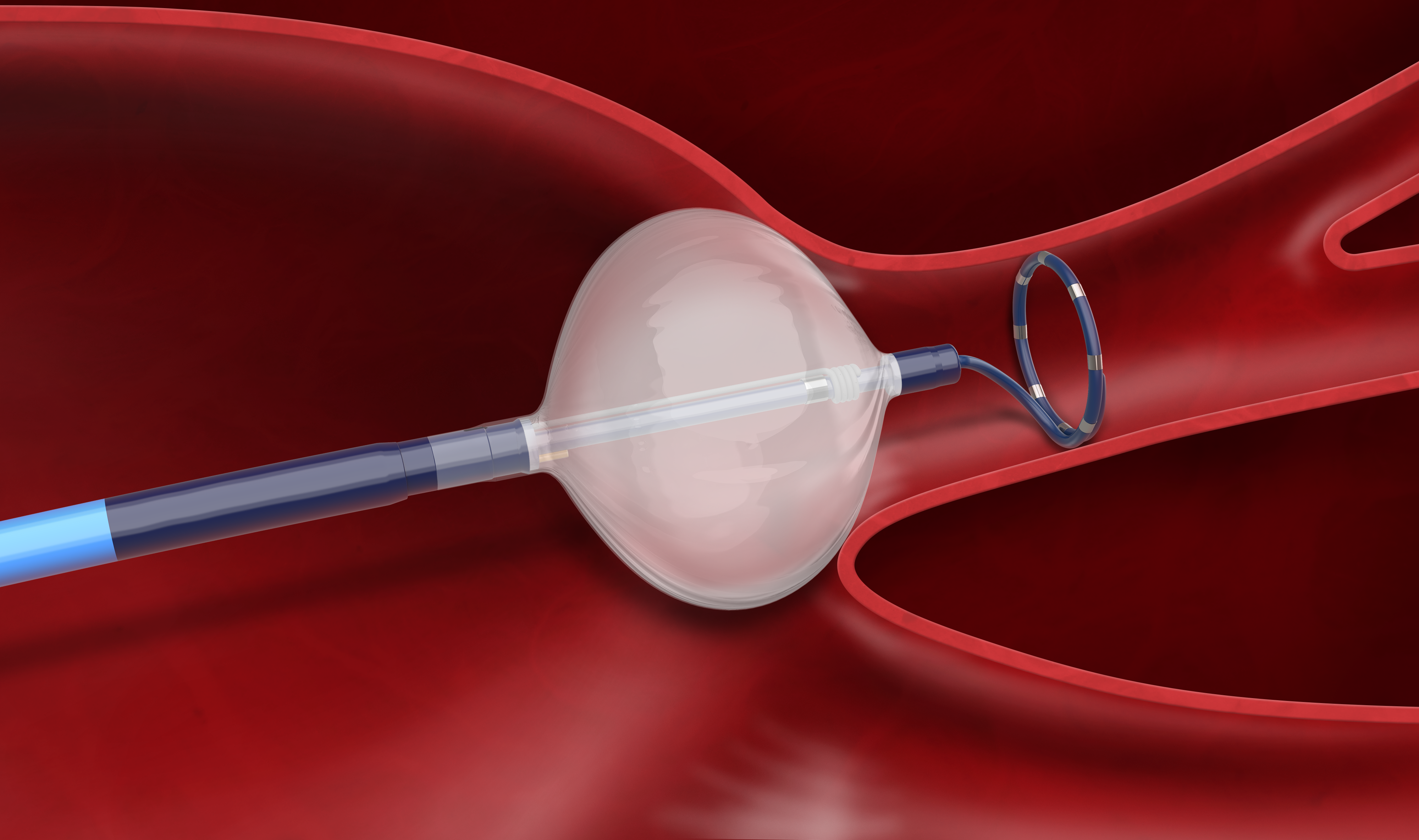 “NUOVA” CRIOABLAZIONE PER TRATTARE LA FIBRILLAZIONE ATRIALE