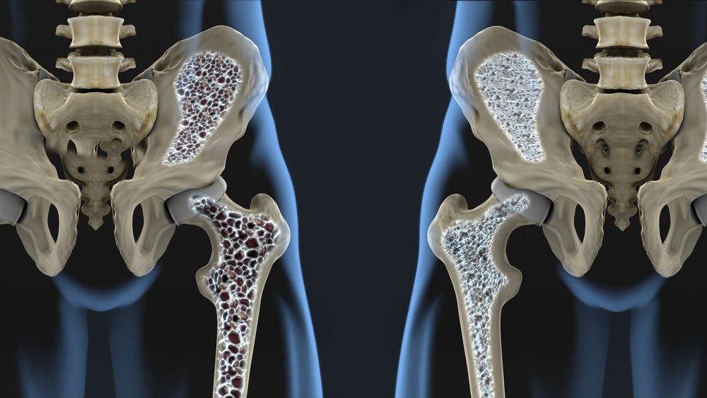 OSTEOPOROSI E’ ALLARME SOCIALE