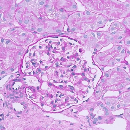 SINDROME NEFROSICA: SU LANCET IL VADEMECUM