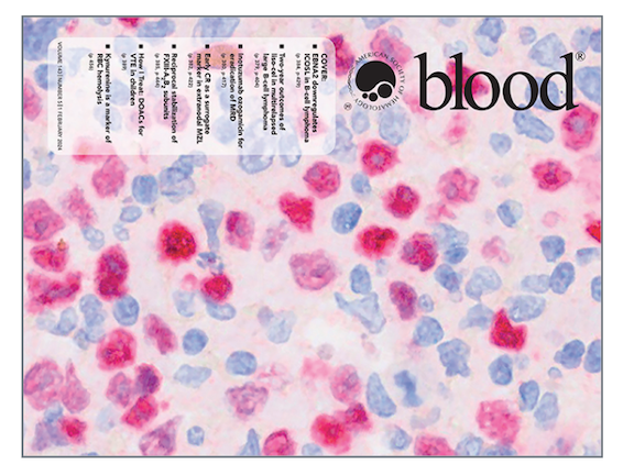 LINFOMI ASSOCIATI AL VIRUS EPSTEIN-BARR: IDENTIFICATO IL MECCANISMO