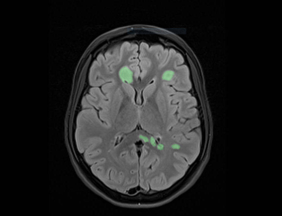 GIORNATA MONDIALE DELLA SCLEROSI MULTIPLA, IL CENTRO DEL BAMBINO GESU’ COMPIE 10 ANNI