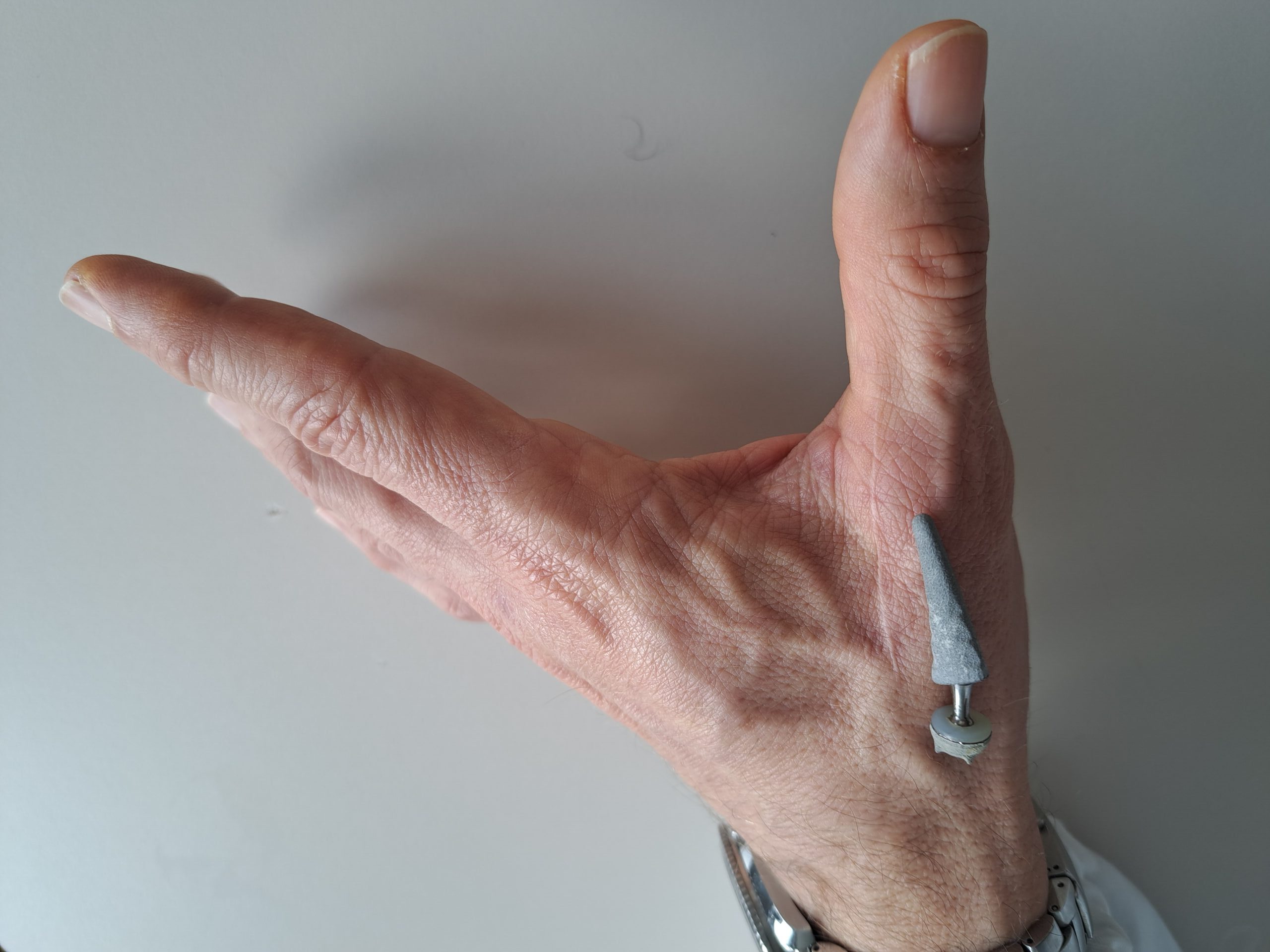 Artrosi, una miniprotesi ispirata all’anca per ridare mobilità al pollice