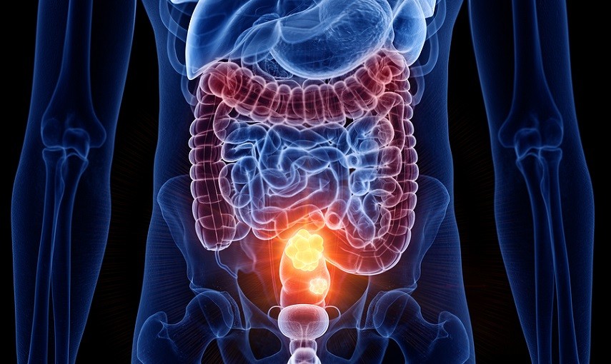 Screening per il tumore al colon retto al Grassi di Ostia