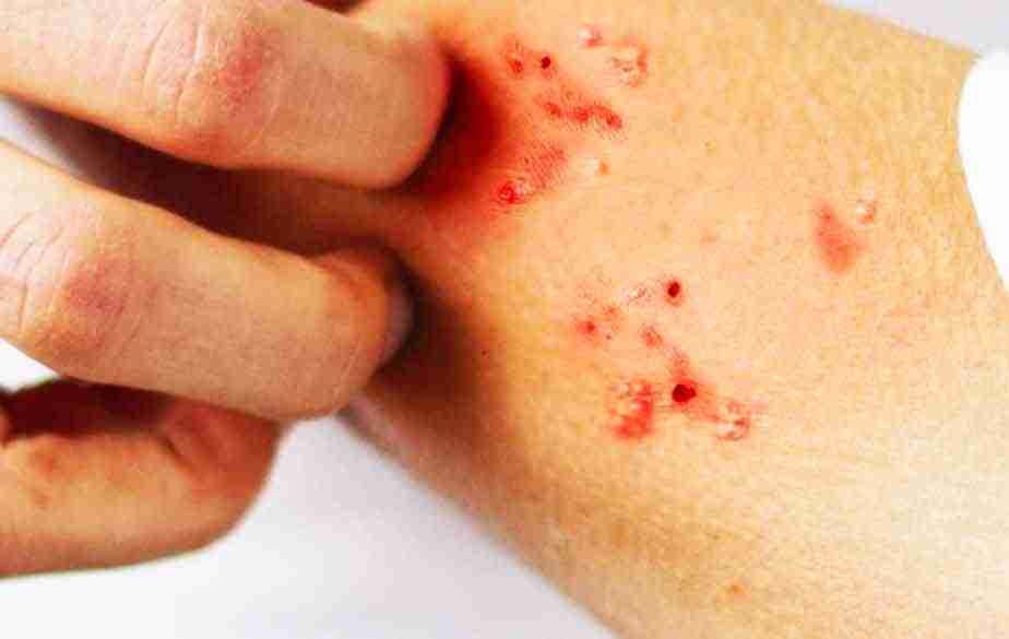 Scabbia in aumento: il ruolo chiave degli Assistenti Sanitari nella prevenzione