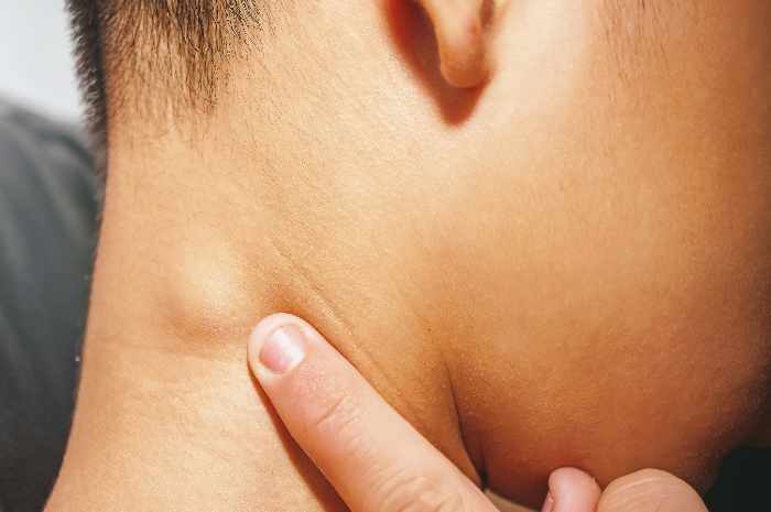 La Sindrome di Castleman, una malattia ancora poco conosciuta