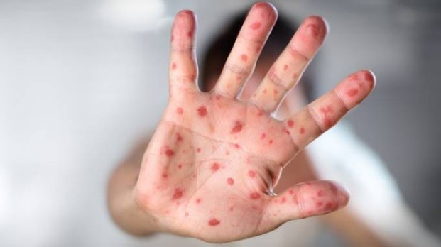 Boom del morbillo: allarme in USA, Europa e Italia