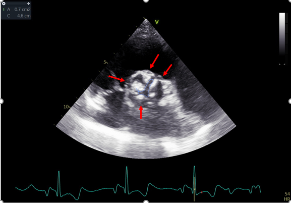 Campania: primo impianto TAVI in Italia con nuova tecnologia per la stenosi aortica